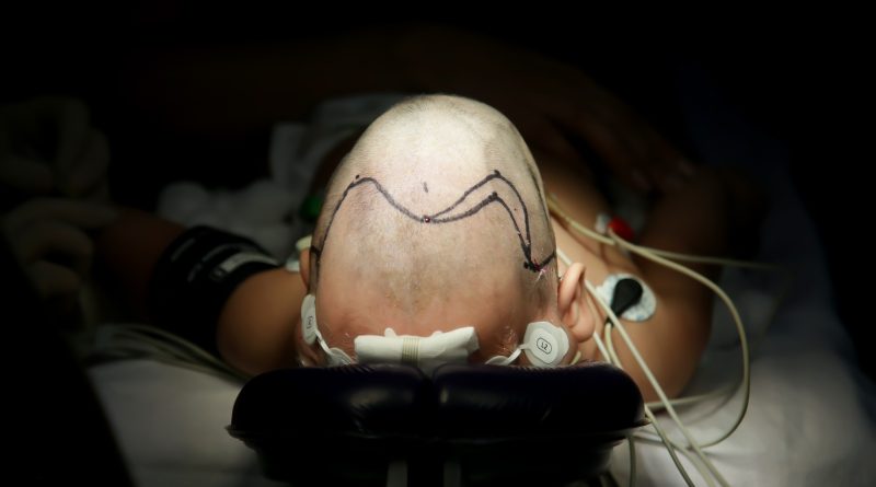 Hospital General CMN La Raza IMSS realiza primera jornada de craneosinotosis en México