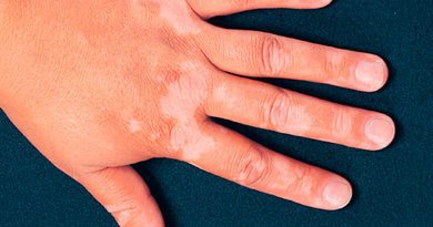 Vitíligo no es contagioso es un trastorno inmunológico:Salud