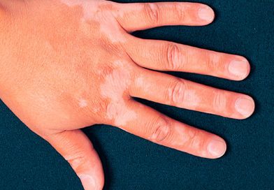 Vitíligo no es contagioso es un trastorno inmunológico:Salud