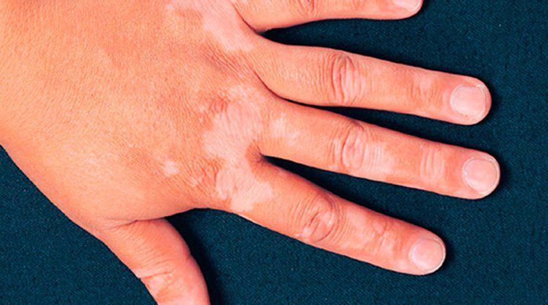 Vitíligo no es contagioso es un trastorno inmunológico:Salud